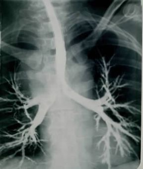 Broncografia di albero bronchiale alterato da bronchiettasia (le diramazioni bronchiali intrapolmonari appaiono dilatate).De Agostini Picture Library
