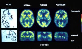Esempio di scintigrafia a emissione di positroni. Placebo. La PET o scintigrafia a emissione di positroni è un esame neurologico non invasivo che permette di evidenziare il tessuto encefalico e in particolare l'area corticale. È così possibile mappare alcune patologie. Nell'immagine si nota come le aree di attivazione corticale (in rosso), in seguito all'attività cognitiva, sono più estese nel soggetto normale rispetto al soggetto affetto da demenza di Alzheimer.