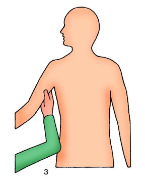 Punto di compressione arteriosa in caso di ferita al braccio. La compressione arteriosa. In caso di ferite al braccio si comprime tra spalla e gomito, sul lato interno.