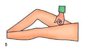 Punto di compressione arteriosa in caso di ferita vicino alla piega dell'inguine. La compressione arteriosa. In caso di ferita vicino alla piega dell’inguine si comprime alla piega dell’inguine con il pugno, a braccio teso.