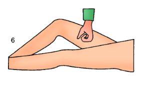 Punto di compressione arteriosa in caso di ferita alla coscia. La compressione arteriosa. In caso di ferita alla coscia si comprime la faccia interna della coscia con il pugno, a braccio teso.