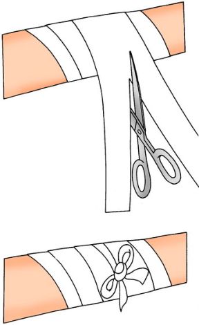 Effettuare una corretta fasciatura: fissaggio della medicazione. Come fare una fasciatura. Dopo aver avvolto la benda a spirale, tagliare l’ultimo tratto di benda.