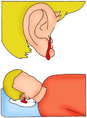 Sintomi delle fratture craniche. Fratture e lussazioni. Tra i segni delle fratture craniche va annoverata l'emorragia dalle orecchie e/o dal naso.