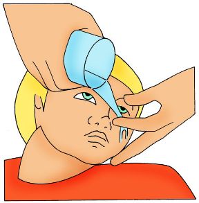 Corpo estraneo nell'occhio: lavaggio delicato. Corpi estranei nell'occhio. Se l’operazione non riesce, provate con un lavaggio delicato dell’occhio.