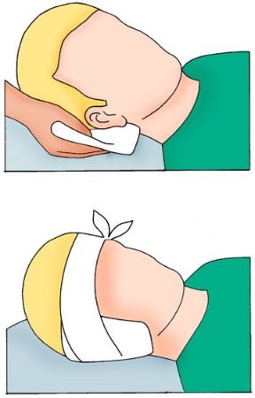 Intervento in caso di otarragia: applicazione di una garza. Otarragia. Applicate sull’orecchio una compressa di garza sterile o un fazzoletto pulito e fermate con una benda.