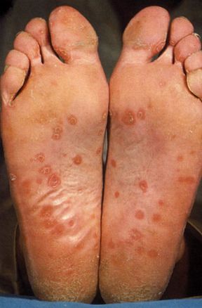 Caso di sifilide secondaria. Dermatologia. La sifilide secondaria si manifesta a livello cutaneo con maculo-papule eritematose che possono localizzarsi al palmo delle mani, o alla pianta dei piedi, come in questo caso.