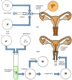I due metodi della inseminazione artificiale. Inseminazione artificiale. a: GIFT, i gameti vengono introdotti nella tuba; b: FIVET, l’uovo già fecondato in vitro viene posto nella cavità uterina perché si impianti.