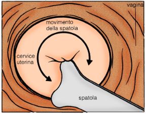 Descrizione del Pap-test. Pap-test. Il test di Papanikolau o pap-test consiste nel prelievo di alcune cellule della cervice uterina tramite un piccolo raschiamento eseguito con una spatola, come mostrato in figura.