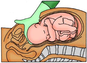 Intervento di parto cesario. Parto cesareo. Oltre ai tagli cesarei eseguiti d’urgenza, talvolta è possibile programmare il parto con questa modalità; le indicazioni principali al cesareo sono le presentazioni anomale del feto (di faccia, di fronte, di spalla, podalico), la sproporzione tra il bacino materno toppo piccolo e la testa fetale, la gravidanza gemellare, la prematurità, le anomalie dell’utero o di posizione della placenta. 