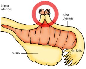 Intervento di chiusura delle tube. Chiusura delle tube. La legatura delle salpingi uterine è una tecnica di sterilizzazione femminile che impedisce il passaggio dell'uovo nella cavità uterina.