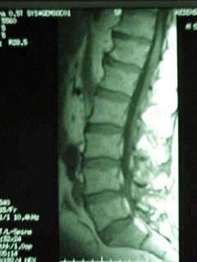 RMN spinale. Risonanza magnetica nucleare. La RMN della colonna vertebrale permette di evidenziare in dettaglio le strutture ossee e legamentose della colonna.