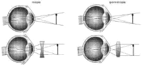 Figura 23.10 I difetti della vista: nel caso della miopia (A) l'immagine si forma davanti alla retina e la correzione avviene utilizzando lenti divergenti; nell'ipermetropia (B) l'immagine si forma oltre la retina e la correzione avviene con lenti convergenti.