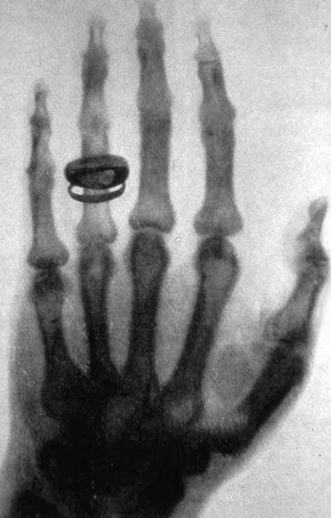 prima-radiografia-rontgen.jpg