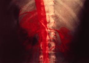 Aortografia translombare. In rosso l'aorta e i suoi rami.De Agostini Picture Library