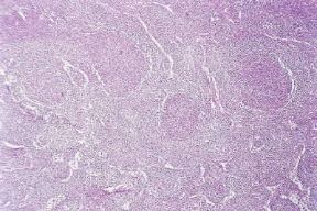 Iperplasia . Sezione del linfonodo del collo con chiara iperplasia dei follicoli.De Agostini Picture Library