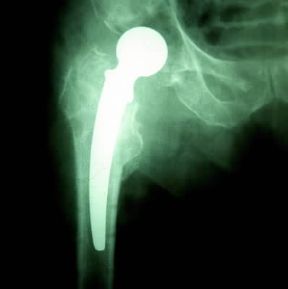 Protesi. Immagine radiografica dell'anca dopo la sostituzione.De Agostini Picture Library
