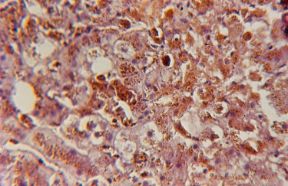 Il diabete mellito. Diabete. Nel tessuto epatico di questo paziente, affetto da diabete mellito, sono evidenti le tracce lasciate dalla sindrome dismetabolica.