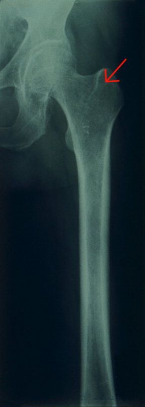 L'osteoporosi. Femore. L'osteoporosi è una delle patologie che più frequentemente affliggono le persone anziane. Purtroppo la fragilità ossea può comportare gravi conseguenze come la rottura del femore, in caso di caduta. La freccia indica una zona di rarefazione della densità calcica.