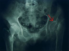 Radiografia del bacino. Bacino. La radiografia mette in rilievo l'osteoporosi a carico delle ossa del bacino. Sono visibili le alterazioni degenerative dovute all'insufficiente elaborazione della matrice proteica (freccia).