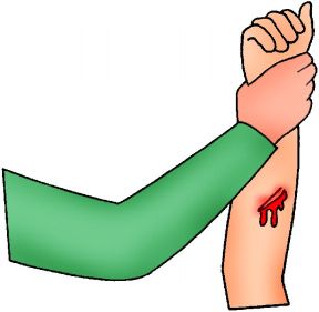 Controllo della perdita di sangue in caso di ferita. Emorragie esterne. Per controllare la perdita di sangue si può sollevare la parte ferita in modo che si trovi sopra il livello del cuore.