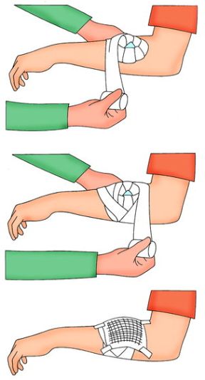 Intervento su ferita con corpo estraneo: fissaggio del tampone. Ferite con corpo estraneo. Fermate il tampone sistemato sulla ferita con due giri di benda.