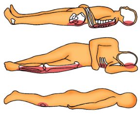 Come evitare piaghe da decubito. Decubito. Una prolungata permanenza a letto, soprattutto nei pazienti anziani, può causare gravi complicazioni come le piaghe da decupito.