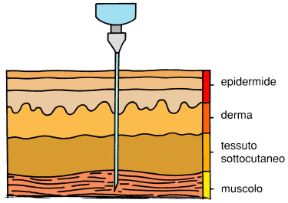 L'iniezione intramuscolare. L'iniezione. L'iniezione intramuscolare consiste nell'introduzione di farmaci direttamente nel tessuto muscolare, al fine di garantire un assorbimento completo del farmaco nel giro di mezz'ora.