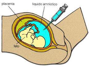 Descrizione dell'amniocentesi. Amniocentesi. Se effettuato precocemente, il prelievo di liquido amniotico permette la diagnosi di alcune malattie ereditarie del feto, come la sindrome di Down.