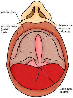 Rappresentazione della palatoschisi. Palatoschisi. La palatoschisi è una delle malattie ereditarie che colpiscono i bambini. Può essere accompagnata da labbro leporino.