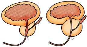 Raffigurazione della prostata. Prostata. a: prostata normale; b: la prostata ipertrofica ostacola lo svuotamento della vescica, la cui parete si ispessisce per compenso. 