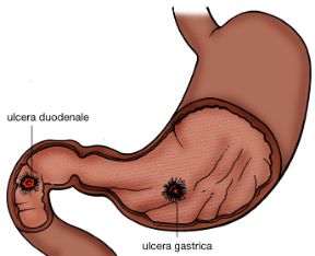 Illustrazione dell'ulcera peptica. Ulcera peptica. Le localizzazioni più frequenti dell'ulcera sono quella gastrica e quella duodenale. L'ulcera è una tipica malattia di tipo psicosomatico la cui insorgenza può essere correlata ad alti livelli di stress.