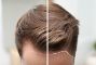 trapianto-capelli.jpg